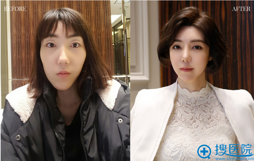 公开我花12万元找韩国菲斯莱茵整形医院李真秀做双颚手术的经历