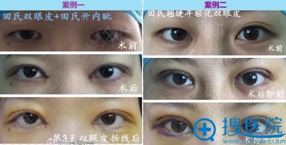 <!--<i data=20240710 data-id=12686></i>-->田氏双眼皮对比图 <!--<i data=20240710 data-id=12686></i>-->田氏双眼皮对比图