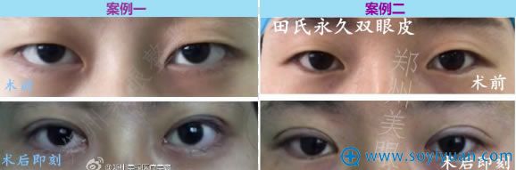 <!--<i data=20240710 data-id=16640></i>-->教授双眼皮真实案例 <!--<i data=20240710 data-id=16640></i>-->教授双眼皮真实案例
