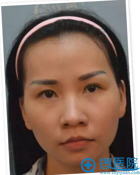 看我在南宁东方医疗美容医院做的鼻综合+丰太阳穴效果怎么样