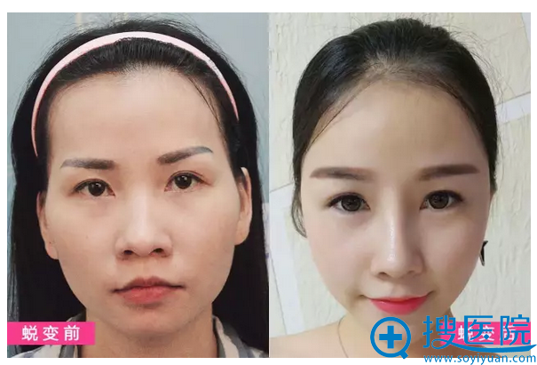 鼻综合+丰太阳穴前后对比照 鼻综合+丰太阳穴前后对比照