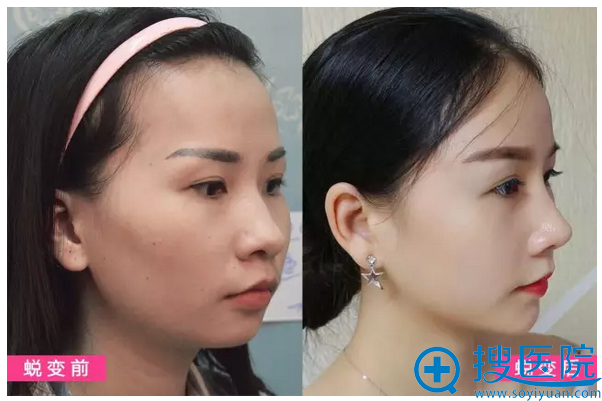 南宁东方鼻综合案例侧面前后对比照效果 南宁东方鼻综合案例侧面前后对比照效果