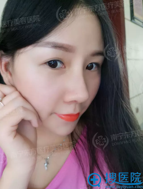 鼻综合+自体脂肪自体脂肪丰太阳穴术后生活照 鼻综合+自体脂肪自体脂肪丰太阳穴术后生活照