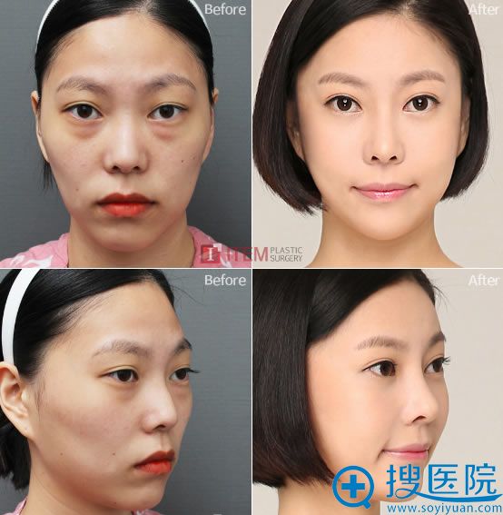 韩国爱婷整形颧骨缩小恢复效果 韩国爱婷整形颧骨缩小恢复效果
