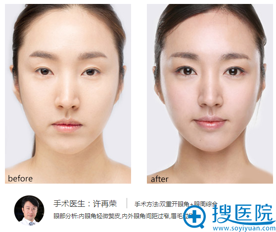 上海华美<!--<i data=20240710 data-id=16294></i>-->双眼皮案例 上海华美<!--<i data=20240710 data-id=16294></i>-->双眼皮案例