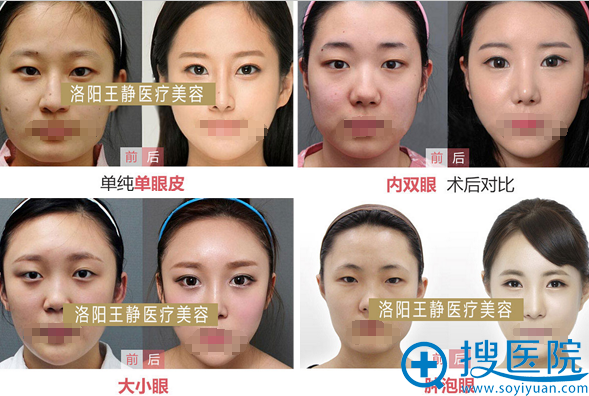 <!--<i data=20240710 data-id=12334></i>-->眼部整形案例对比照片 <!--<i data=20240710 data-id=12334></i>-->眼部整形案例对比照片