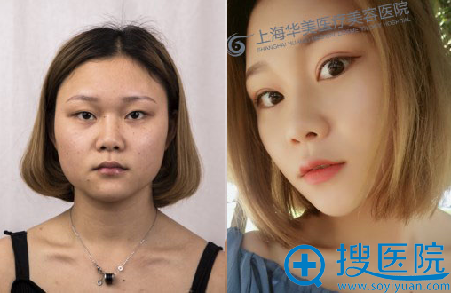 上海华美<!--<i data=20240710 data-id=16301></i>-->主任park法双眼皮对比图 上海华美<!--<i data=20240710 data-id=16301></i>-->主任park法双眼皮对比图