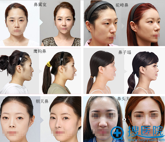 <!--<i data=20240710 data-id=12334></i>-->鼻部整形案例展示 <!--<i data=20240710 data-id=12334></i>-->鼻部整形案例展示