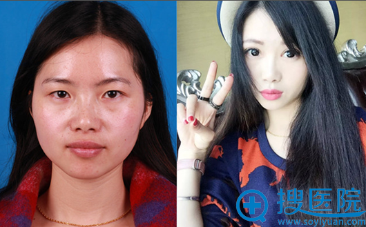 上海华美叶丽萍双眼皮对比案例图 上海华美叶丽萍双眼皮对比案例图