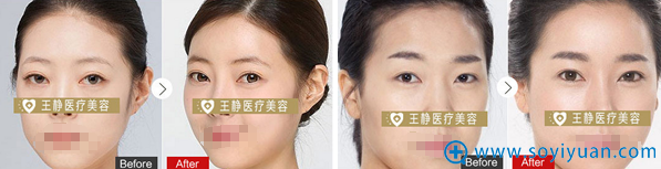 <!--<i data=20240710 data-id=12334></i>-->面部脂肪填充真人案例 <!--<i data=20240710 data-id=12334></i>-->面部脂肪填充真人案例