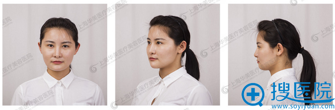 上海华美刘尊敏怎么样 自体脂肪填充案例效果好到连妈妈都心动