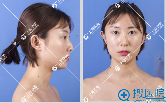 上海华美叶丽萍隆鼻案例 看我驼峰鼻矫正术后3个月效果怎么样