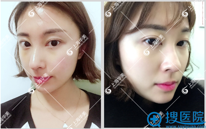 找华美叶丽萍主任做隆鼻一个月效果 找华美叶丽萍主任做隆鼻一个月效果