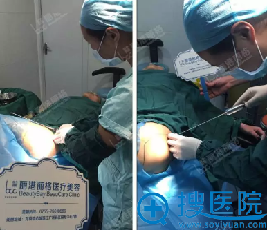 深圳丽港丽格全脸脂肪填充手术进行中 深圳丽港丽格全脸脂肪填充手术进行中