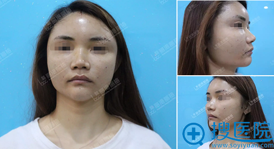 深圳丽港丽格全脸脂肪填充术后即刻效果 深圳丽港丽格全脸脂肪填充术后即刻效果