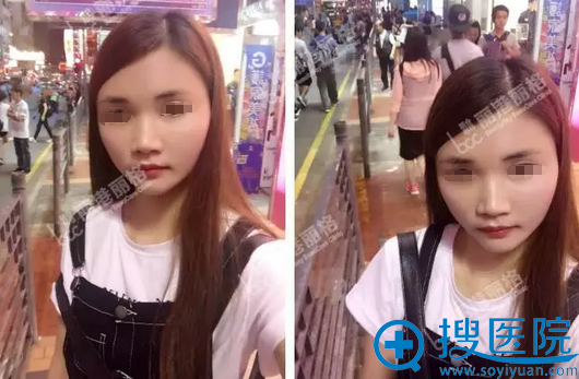 深圳丽港丽格全脸脂肪填充术后20天恢复照片 深圳丽港丽格全脸脂肪填充术后20天恢复照片