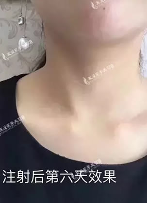 嗨体祛颈纹效果怎么样?广州天姿真人案例15天拥有白皙天鹅颈