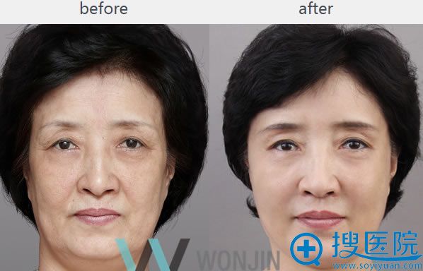 脂肪填充前后对比效果_原辰整形外科 脂肪填充前后对比效果_原辰整形外科