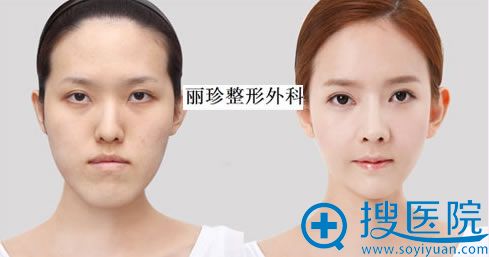 面部轮廓前后对比效果_ 丽珍整形外科 面部轮廓前后对比效果_ 丽珍整形外科