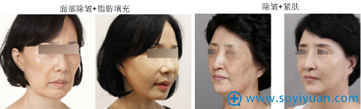 深圳南西子整形美容医院面部年轻化案例 深圳南西子整形美容医院面部年轻化案例
