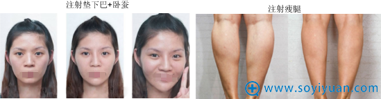 深圳南西子整形美容医院玻尿酸、案例 深圳南西子整形美容医院玻尿酸、案例