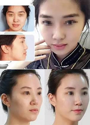贵阳华美整容医院玻尿酸案例大集合 999元就能变成小仙女