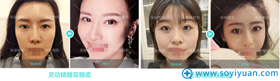 <!--<i data=20240710 data-id=12584></i>-->医疗美容医院双眼皮案例对比照 <!--<i data=20240710 data-id=12584></i>-->医疗美容医院双眼皮案例对比照