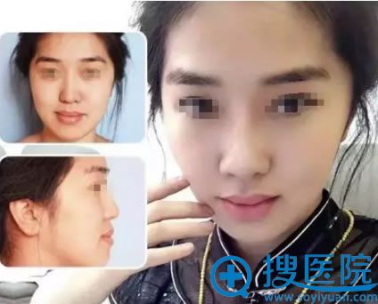 贵阳华美整形医院玻尿酸打苹果肌案例 贵阳华美整形医院玻尿酸打苹果肌案例