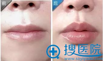 玻尿酸丰唇前后对比效果_贵阳华美整形 玻尿酸丰唇前后对比效果_贵阳华美整形