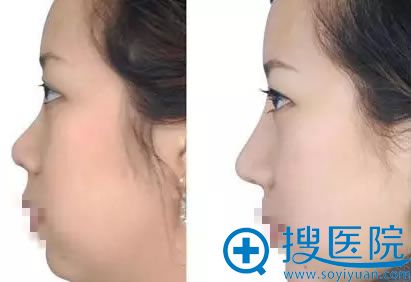 贵阳华美注射隆鼻前后对比照 贵阳华美注射隆鼻前后对比照