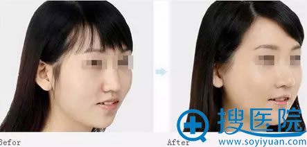 贵阳华美整形玻尿酸丰下巴案例图 贵阳华美整形玻尿酸丰下巴案例图