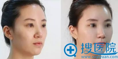 玻尿酸补水嫩肤前后对比案例_贵阳华美 玻尿酸补水嫩肤前后对比案例_贵阳华美