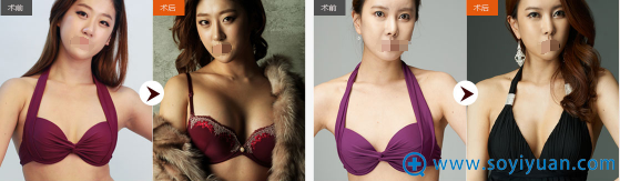 成都铜雀台整形美容医院无痕四维丰胸案例 成都铜雀台整形美容医院无痕四维丰胸案例