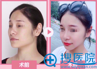 <!--<i data=20240710 data-id=13402></i>-->医学美容医院下颌角案例 <!--<i data=20240710 data-id=13402></i>-->医学美容医院下颌角案例