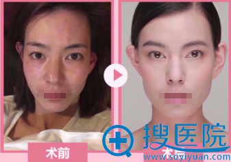 <!--<i data=20240710 data-id=13402></i>-->医学美容医院面部线雕案例 <!--<i data=20240710 data-id=13402></i>-->医学美容医院面部线雕案例