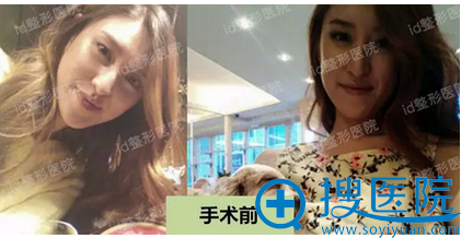 双颚手术术前照片 双颚手术术前照片