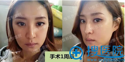 双颚+下颌角术后7天效果 双颚+下颌角术后7天效果