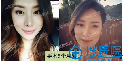 双颚+下颌角术后9个月生活照 双颚+下颌角术后9个月生活照