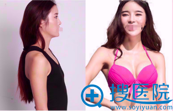 <!--<i data=20240710 data-id=13402></i>-->医学美容医院假体隆胸 <!--<i data=20240710 data-id=13402></i>-->医学美容医院假体隆胸