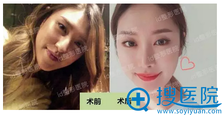双颚+下颌角前后对比照 双颚+下颌角前后对比照