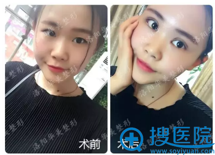洛阳华美双眼皮前后对比照片 洛阳华美双眼皮前后对比照片