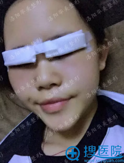术后天的样子 术后天的样子