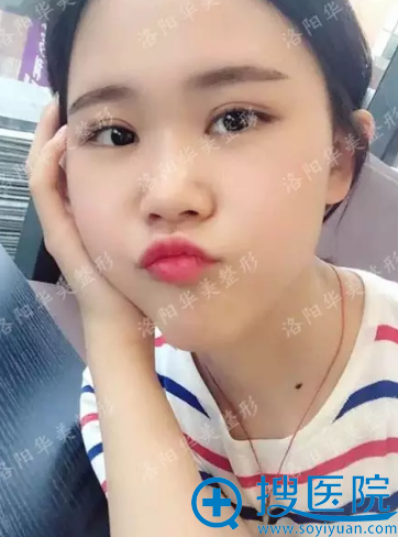 洛阳华美双眼皮术后第30天 洛阳华美双眼皮术后第30天