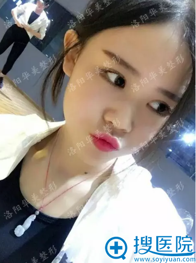 洛阳华美宋俊岭双眼皮术后生活照 洛阳华美宋俊岭双眼皮术后生活照