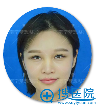南宁梦想整形隆鼻好吗?分享我做完隆鼻变身韩系美女全过程