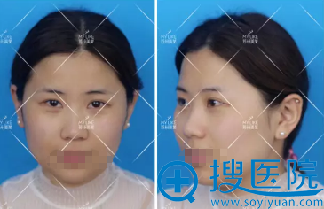 苏州美莱揭秘:鼻子基础好的人和鼻子基础不好的人的隆鼻区别
