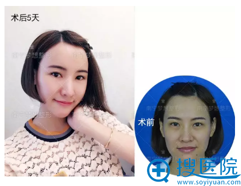 自体脂肪填充术后5天对比图 自体脂肪填充术后5天对比图