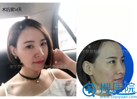 脂肪填充术后14天侧面对比效果 脂肪填充术后14天侧面对比效果