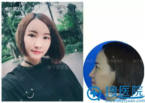 脂肪填充20天侧面对比图 脂肪填充20天侧面对比图