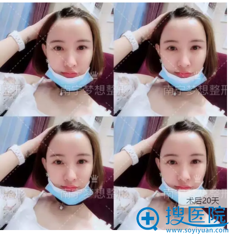 脂肪填充20生活照 脂肪填充20生活照